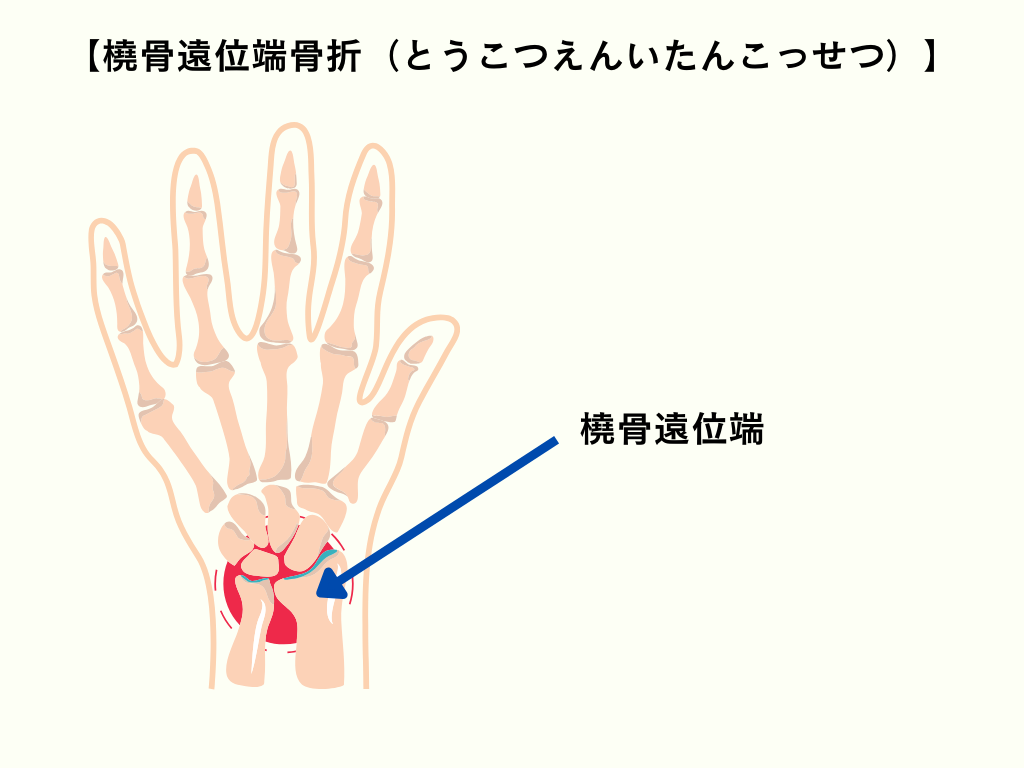 高齢者が骨折しやすい理由とは？骨折の原因や対策のためにすべきこと